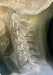 Raideur-cervicale-arthrose-douleurs - Chiropracteur Paris 16 - Chiropracteur Paris 16 Raideur-cervicale-arthrose-douleurs